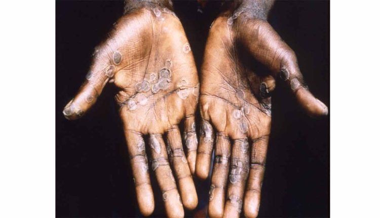 Canada Records 957 Monkeypox Cases