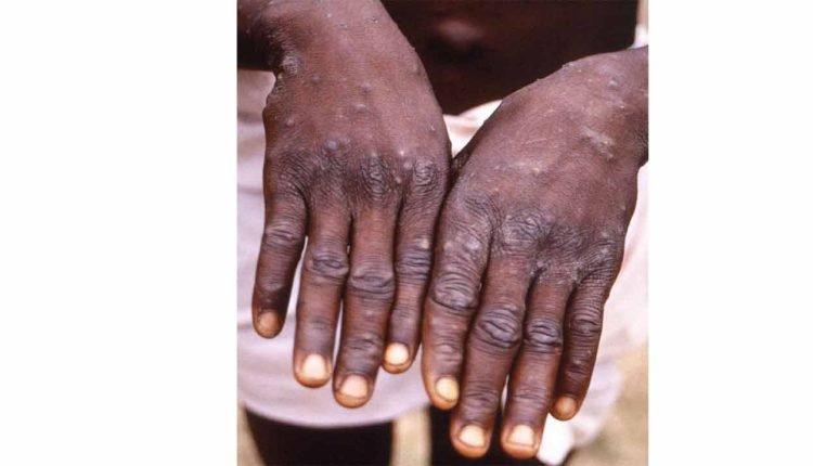 Delhi reports India's fourth, its first monkeypox case