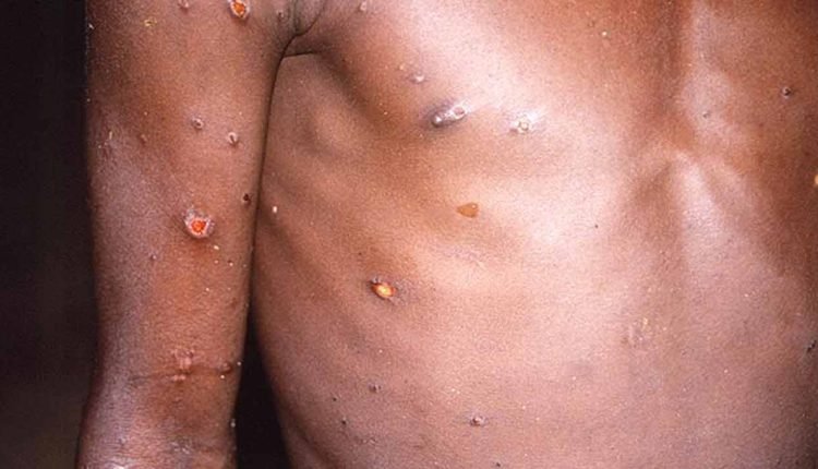 India records the second case of Monkeypox