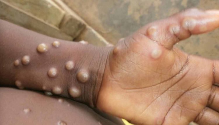 Asia's First Monkeypox Case Reported in Pakistan
