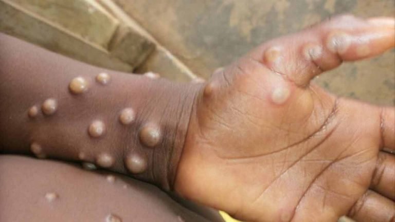 Asia's First Monkeypox Case Reported in Pakistan