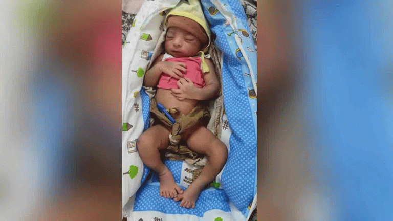 Jagtial: Baby Born With 12 Fingers and 12 Toes
