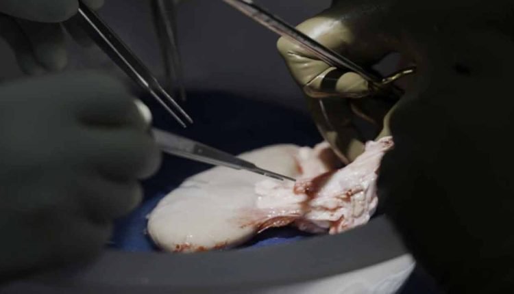 Pig Kidney For A Man: Record Of American Doctors