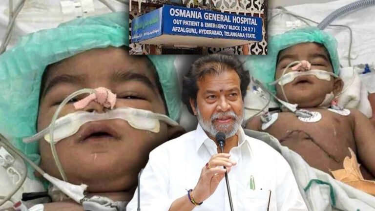 Minister Damodar Praises Osmania Hospital Medical Team For Rare Surgery