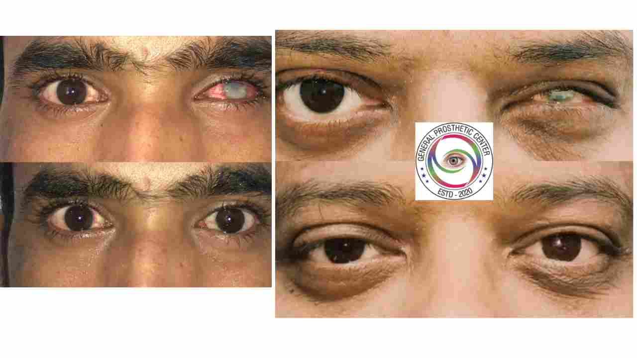 Ilyas Ahmad Ocularist Hyderabad Expert Artificial Eye Specialist